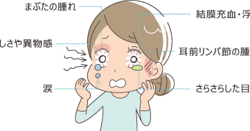 流行性角結膜炎の主な症状