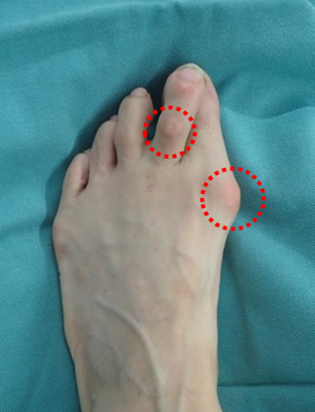 外反母趾で一般的に痛みが出る部位