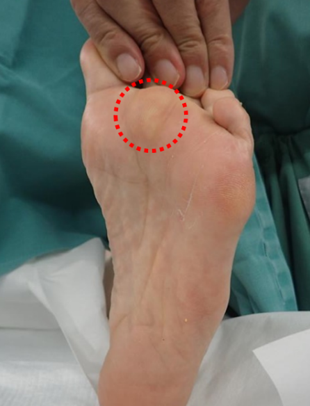 外反母趾で一般的に痛みが出る部位（足裏）