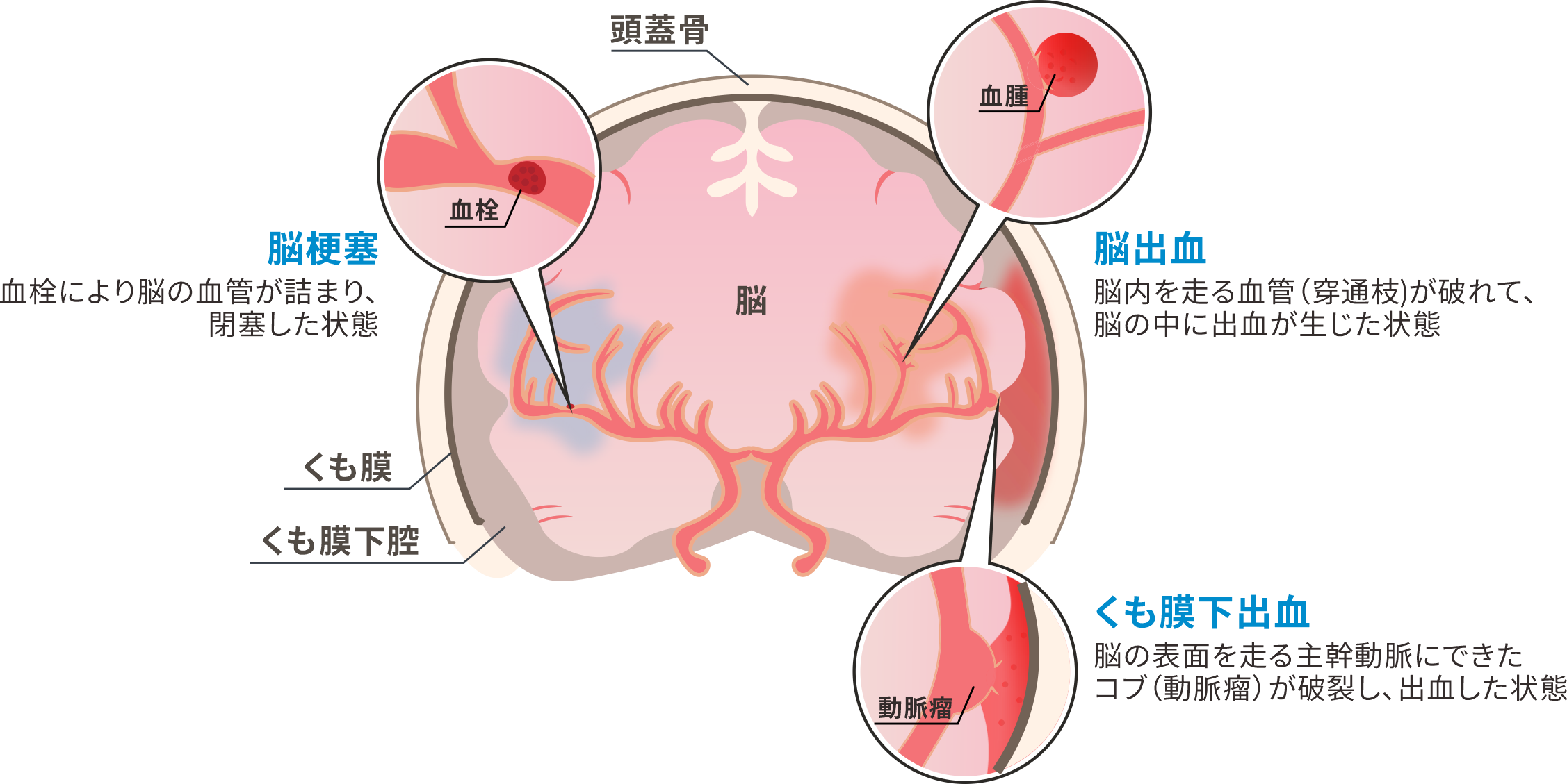 脳卒中 - Online MEWSOnline MEWS