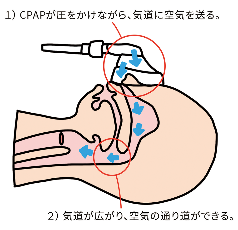 CPAP療法による閉塞の改善