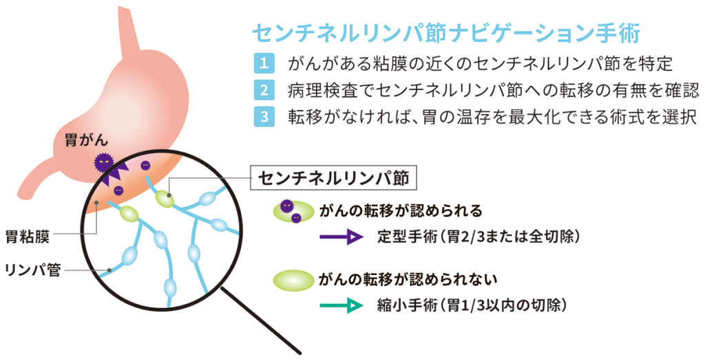 センチネルリンパ節ナビゲーション手術