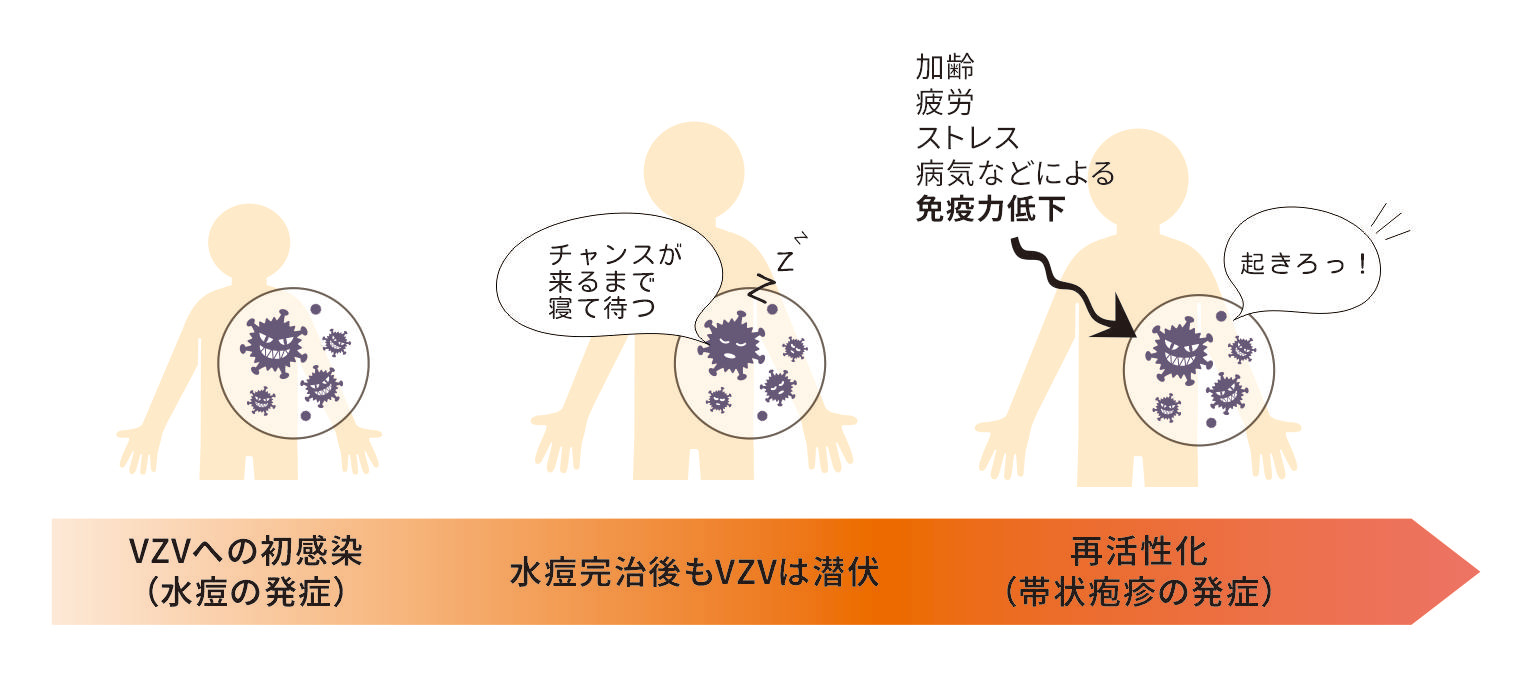 播種 性 帯状 疱疹